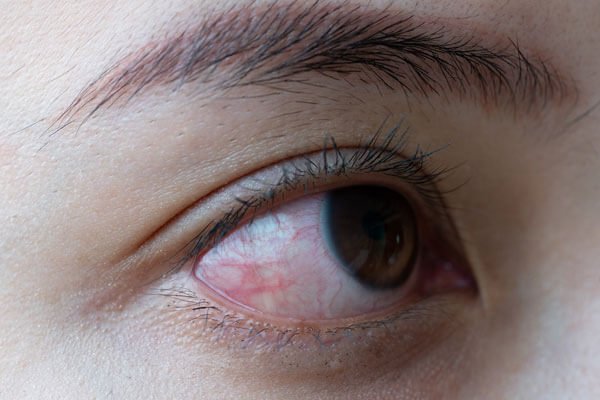 Ayurvedic eye diseases 2